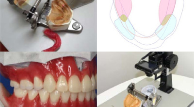 OMデンチャーシステムに基づいた全く新しいコンセプトの総義歯